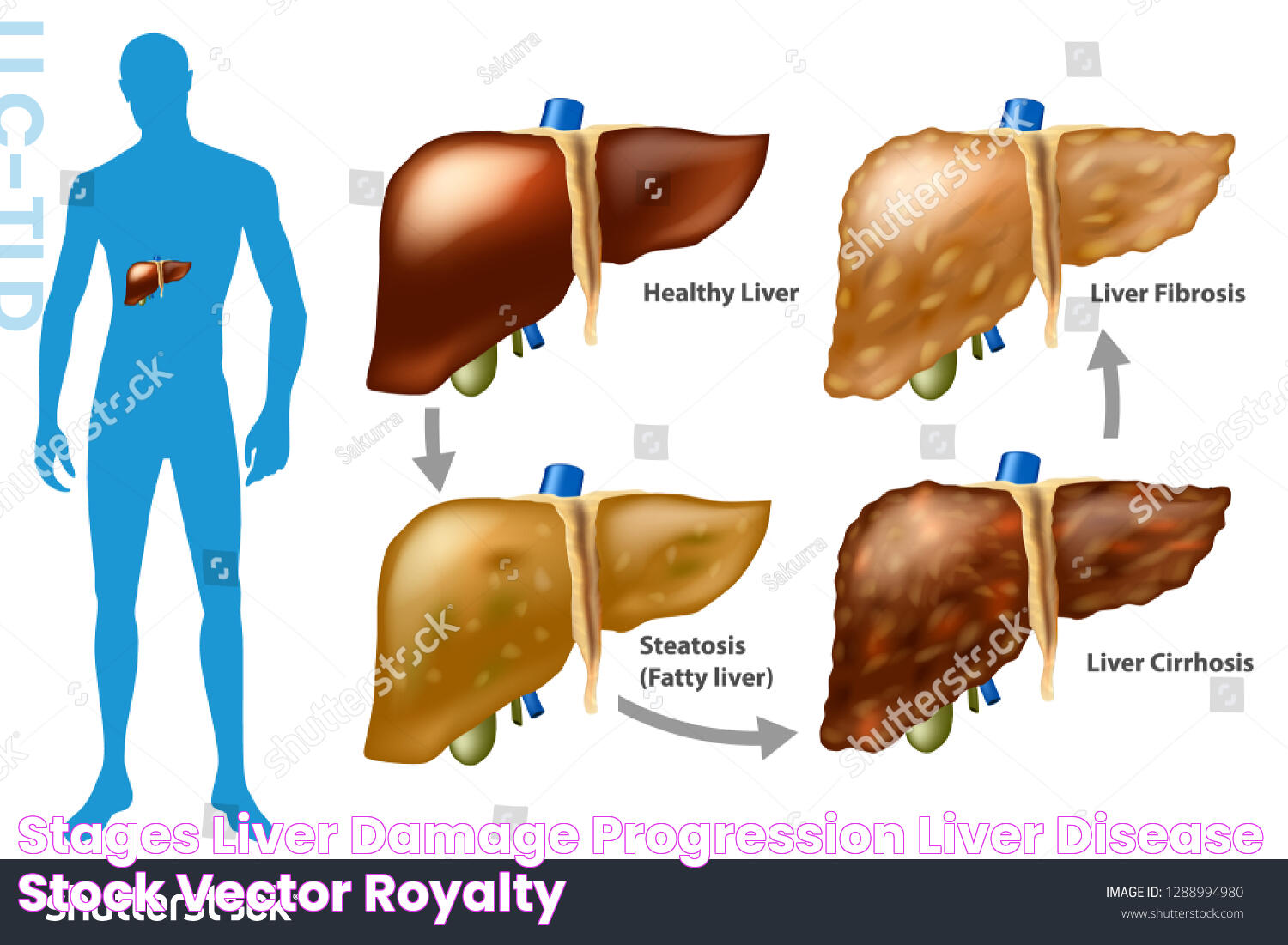 Stages Liver Damage Progression Liver Disease Stock Vector (Royalty