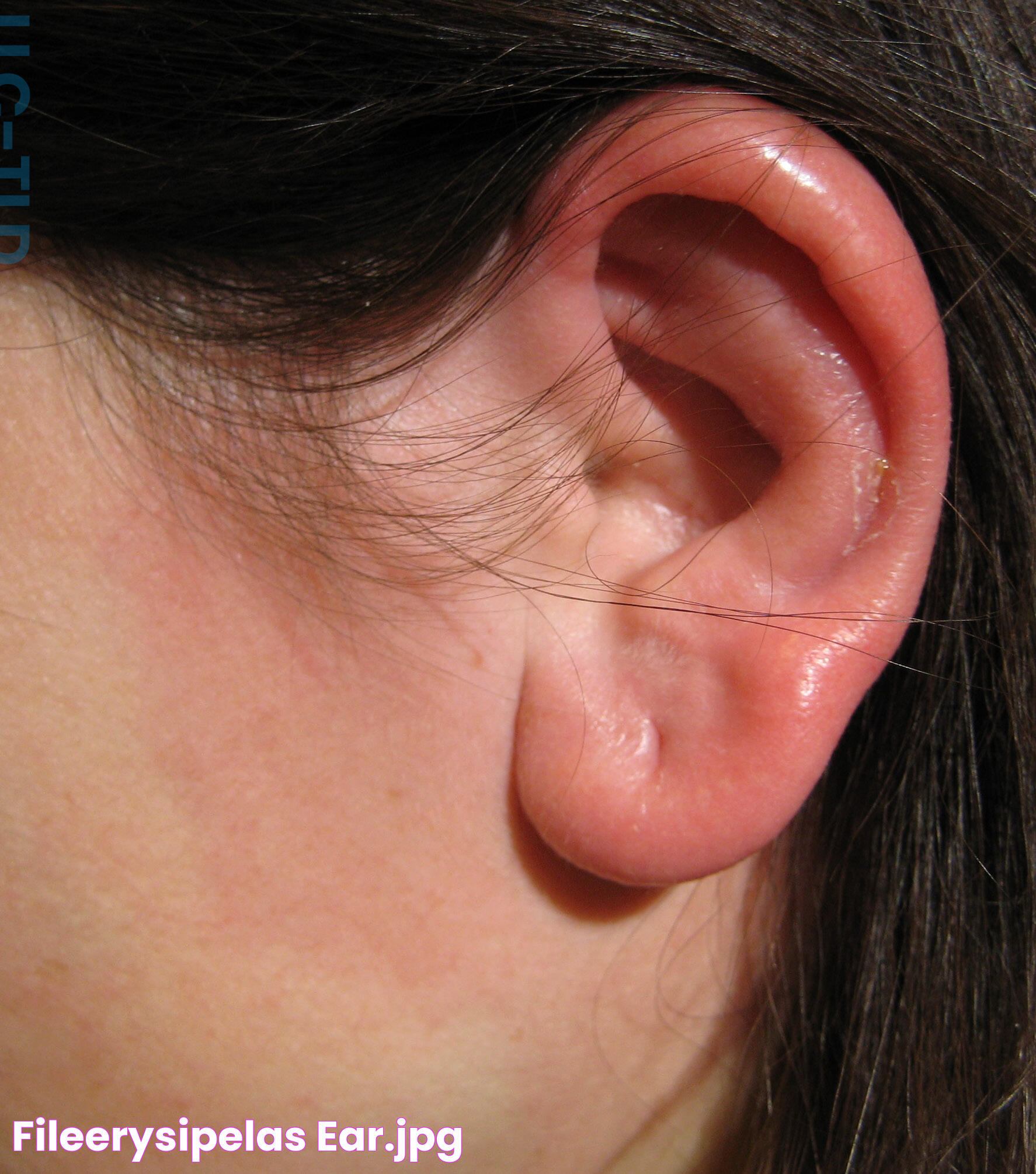 FileErysipelas ear.jpg