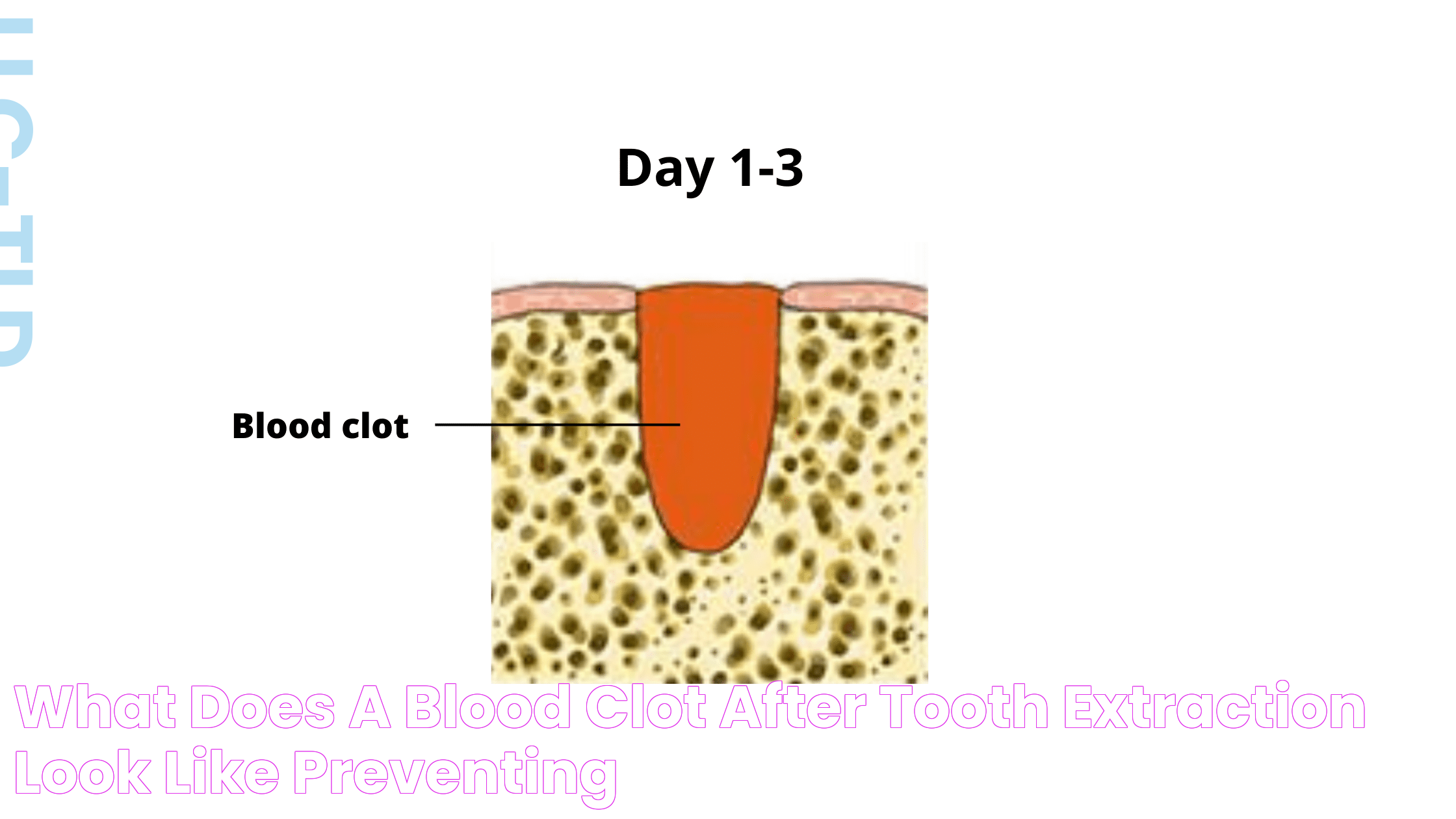 What does a blood clot after tooth extraction look like? Preventing